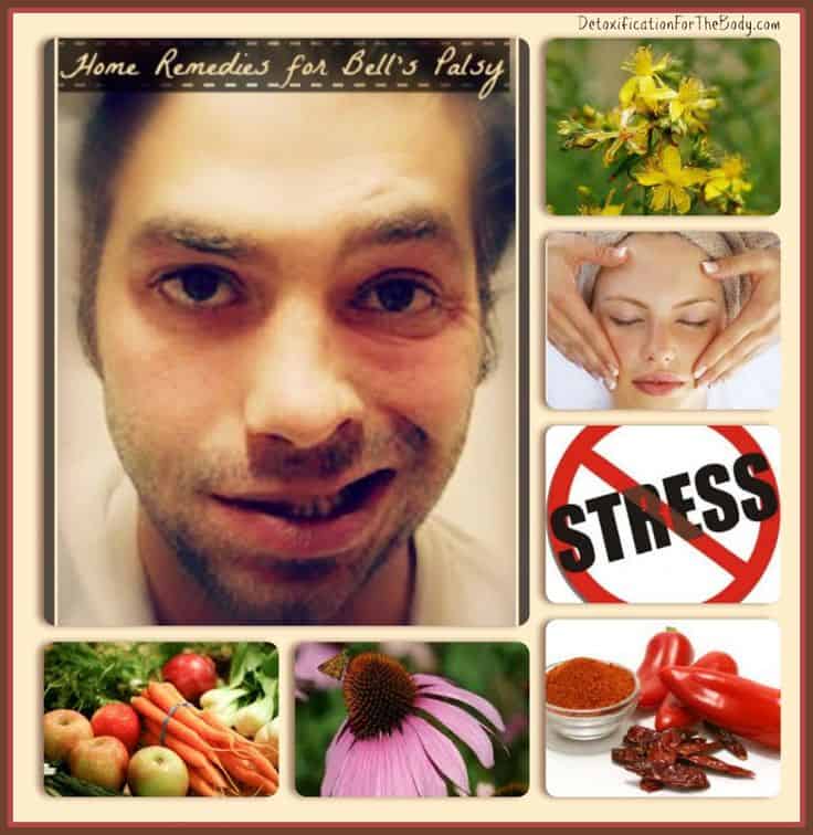 Natural and Alternative Home Remedies for Bell’s Palsy
