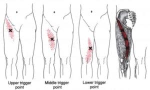 Sartorius,Trigger Point, Diagram