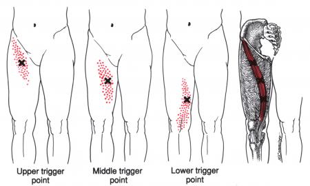 Massage Techniques to Help with Sartorius Pain